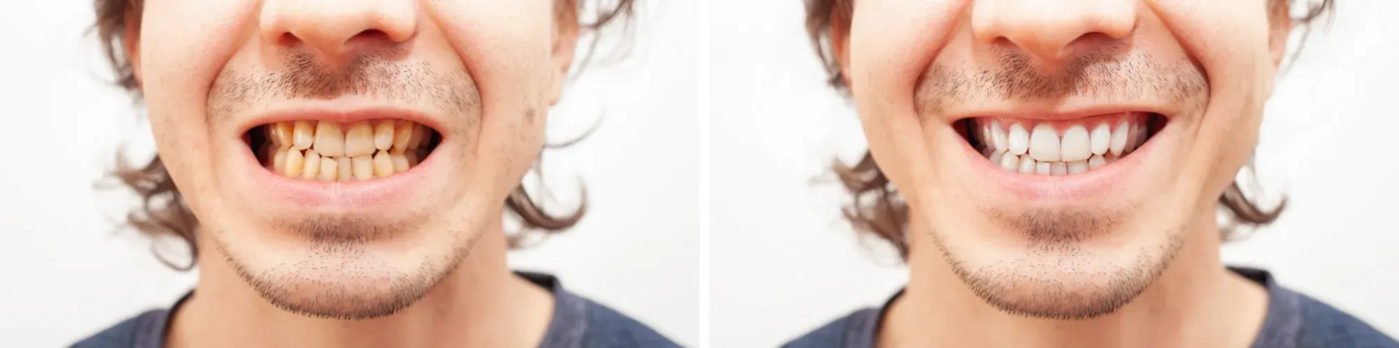 Clear Aligners in Lake Mary - Before and After