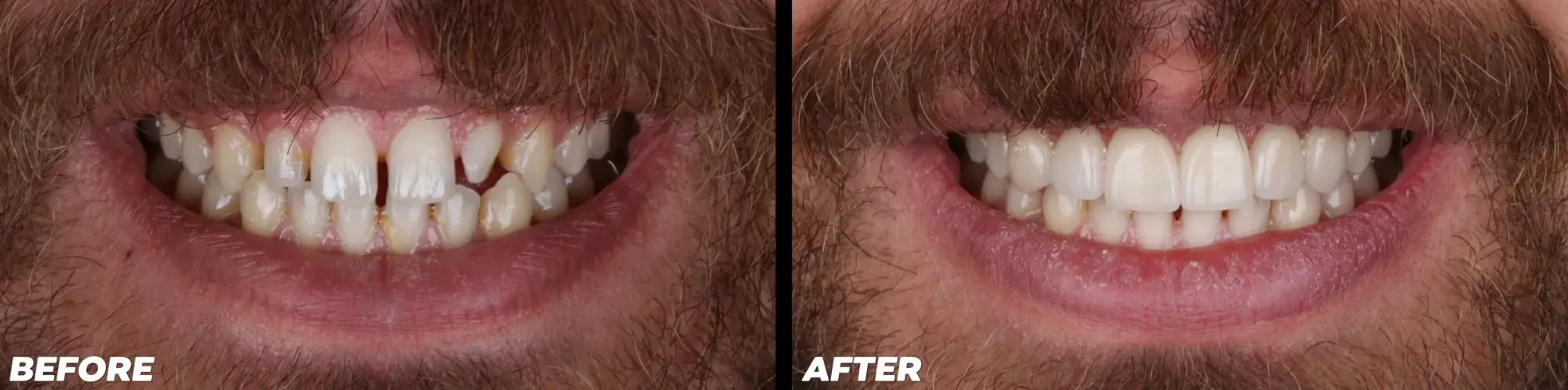 Clear Aligners in Lake Mary - Before and After