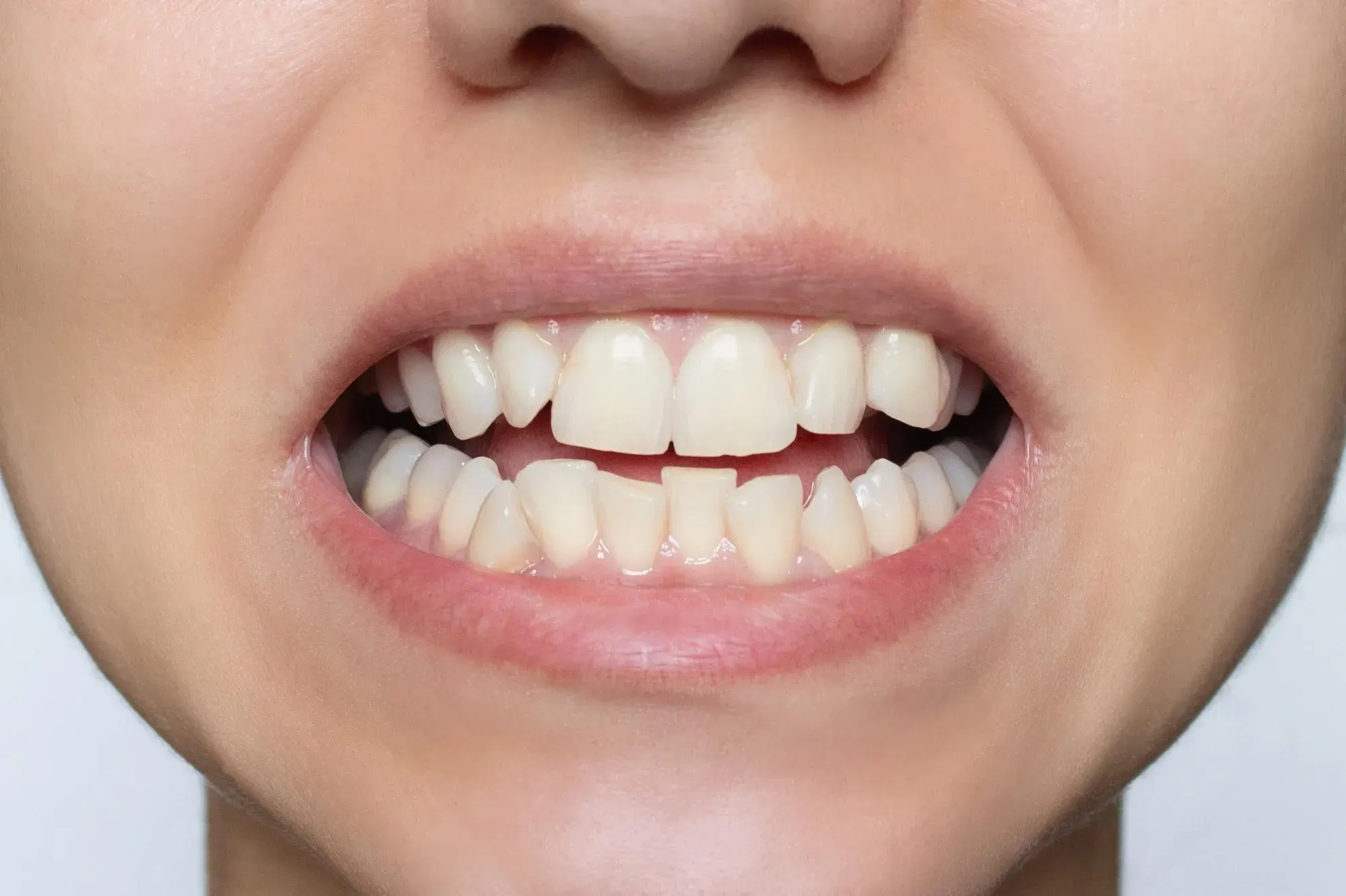 Dental professional explaining crooked teeth and oral health impacts to a patient